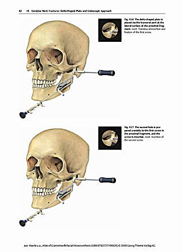 craniomaxillofacial osteosynthesis craniomaxillofacial osteosynthesis