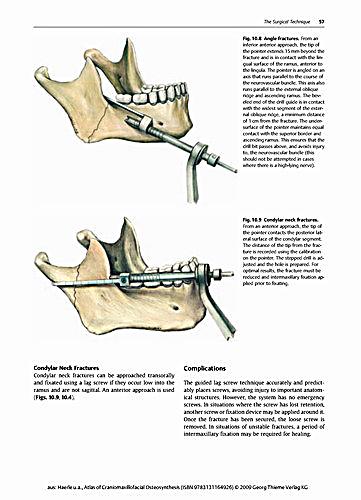 craniomaxillofacial osteosynthesis craniomaxillofacial osteosynthesis