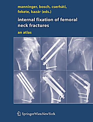 femoral neck fracture fixation