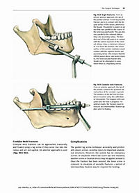atlas of craniomaxillofacial osteosynthesis Now in a long awaited second edition, this groundbreaking atlas of osteosynthesis in craniomaxillofacial and oral surgery has been fully updated to reflect new techniques, applications, instruments, and materials. atlas of craniomaxillofacial osteosynthesis Now in a long awaited second edition, this groundbreaking atlas of osteosynthesis in craniomaxillofacial and oral surgery has been fully updated to reflect new techniques, applications, instruments, and materials.